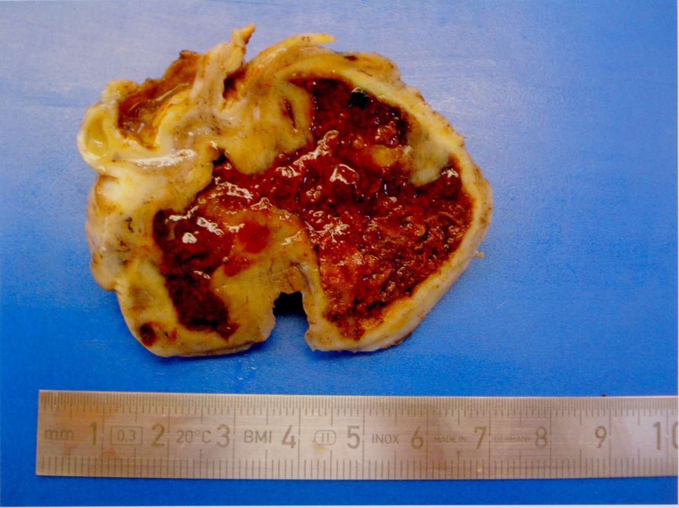Chocolate cyst in endometriosis
