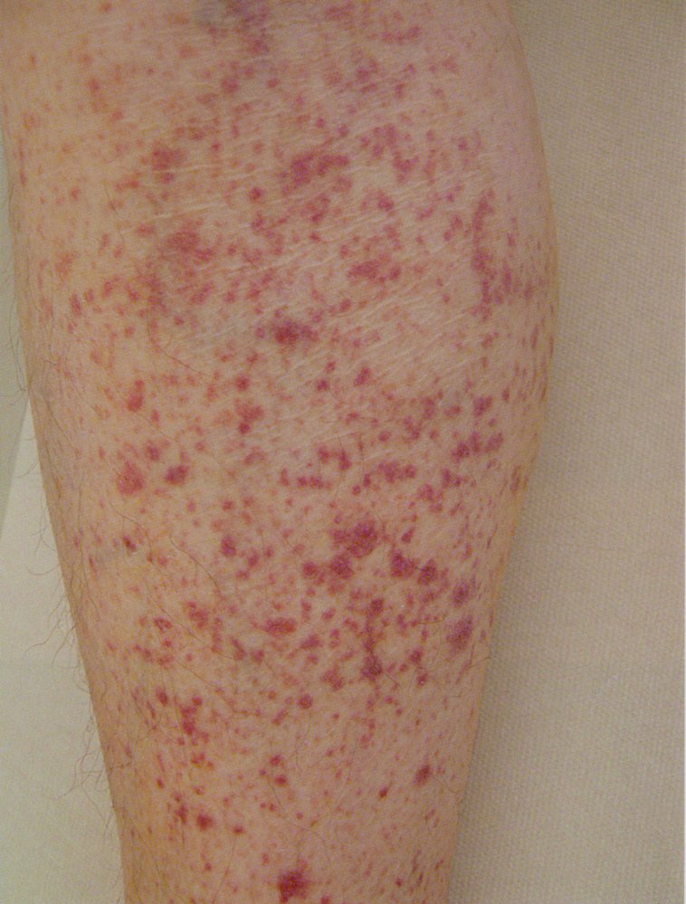 Petechial bleeding due to thrombocytopenia