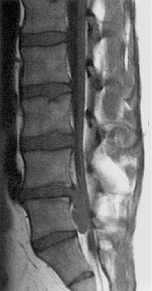 Spinal disk herniation with migration (1/3)