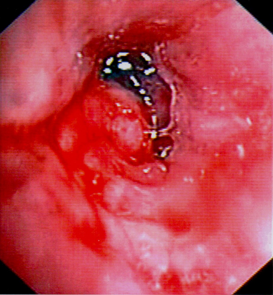 Lung cancer