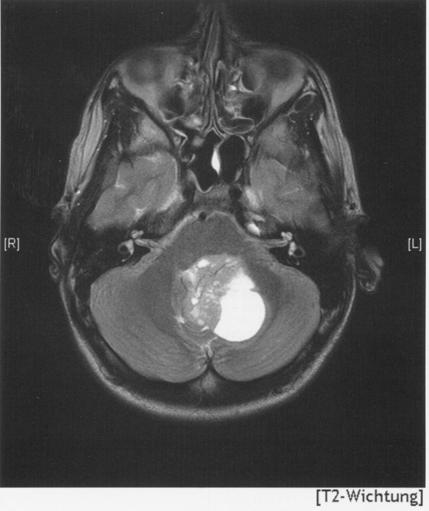 Medulloblastoma in a child