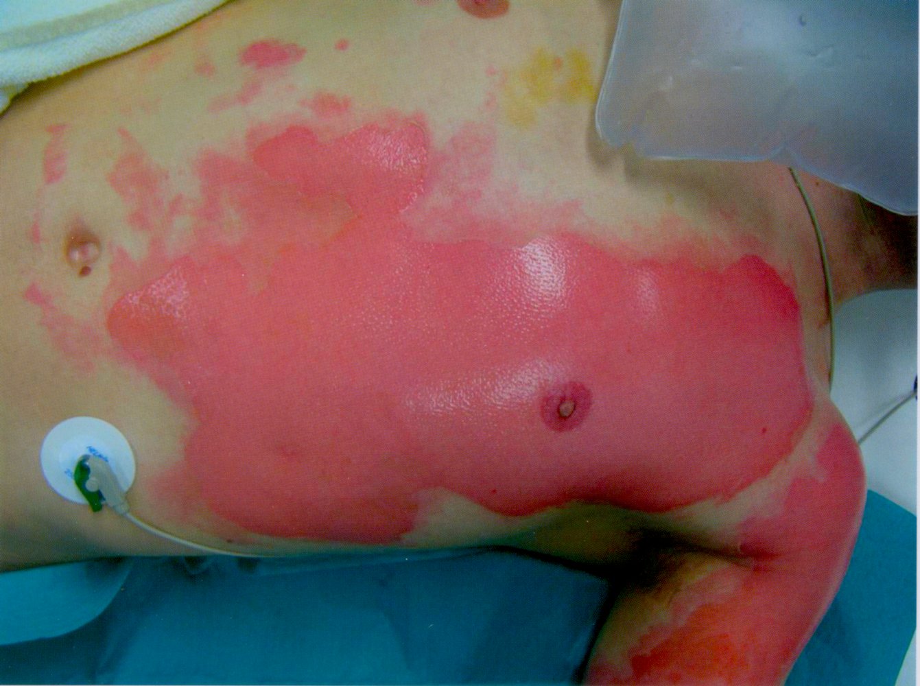 Second-degree burn (2b; deep partial-thickness burn)