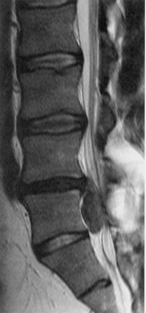 Spinal disk herniation with migration (3/3)