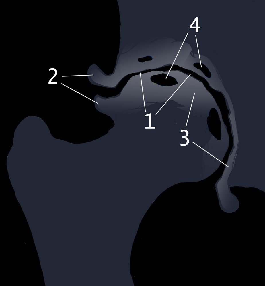 Illustration of right hip radiograph in osteoarthritis