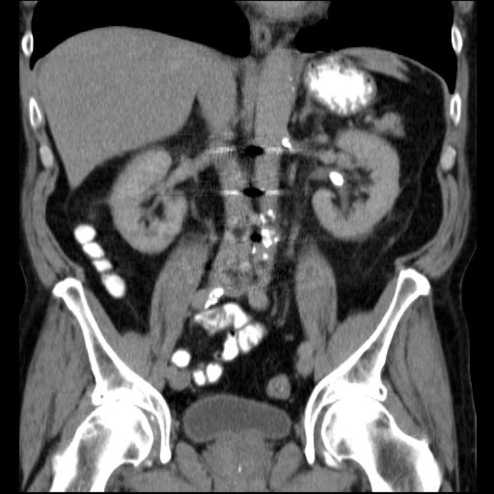Nonobstructive renal calculus (2/2)