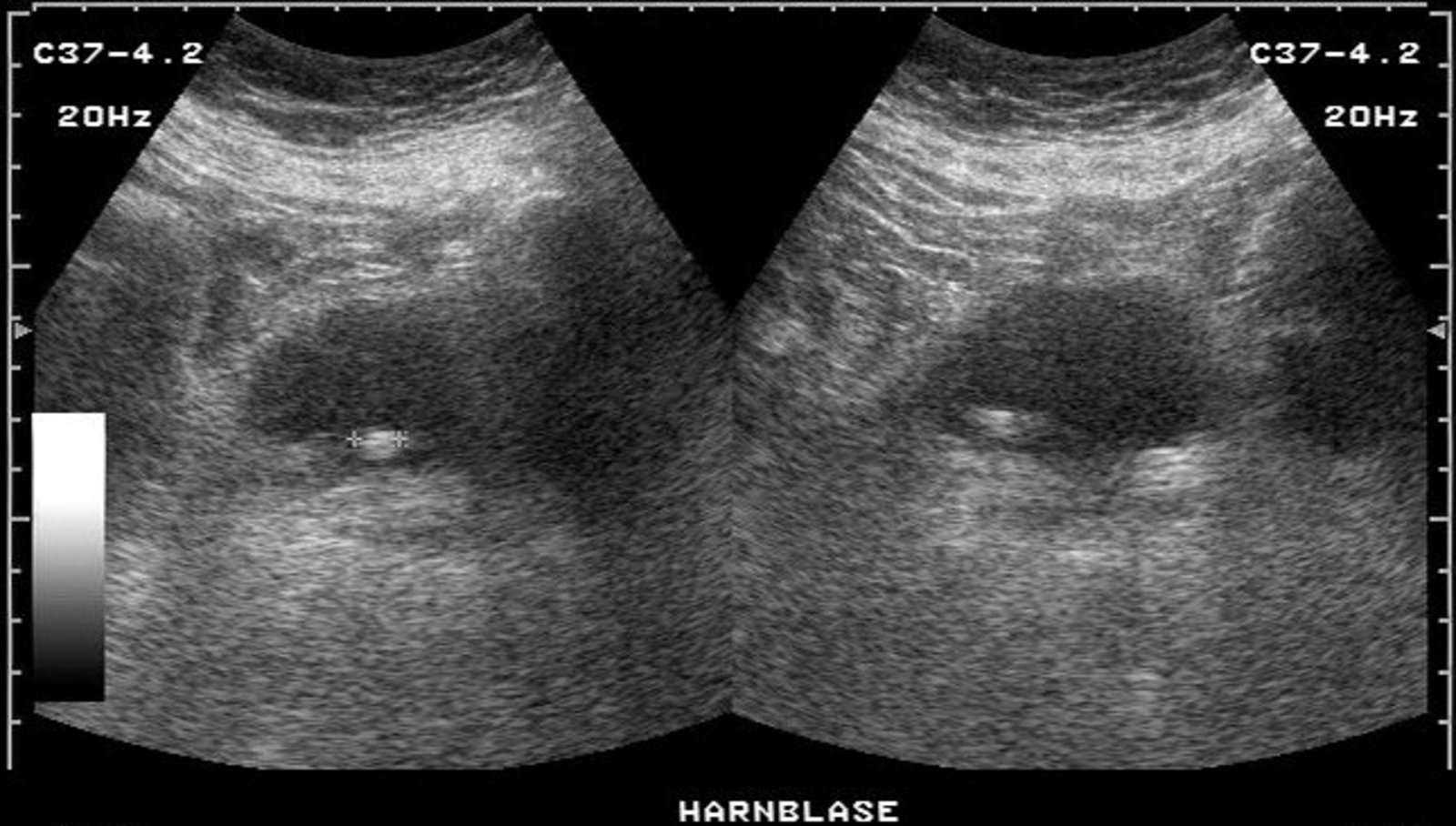 Urinary bladder mass