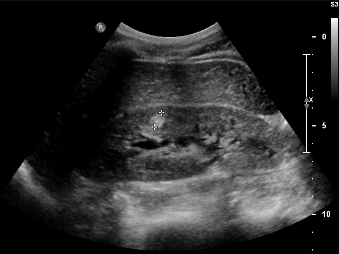 Angiomyolipoma