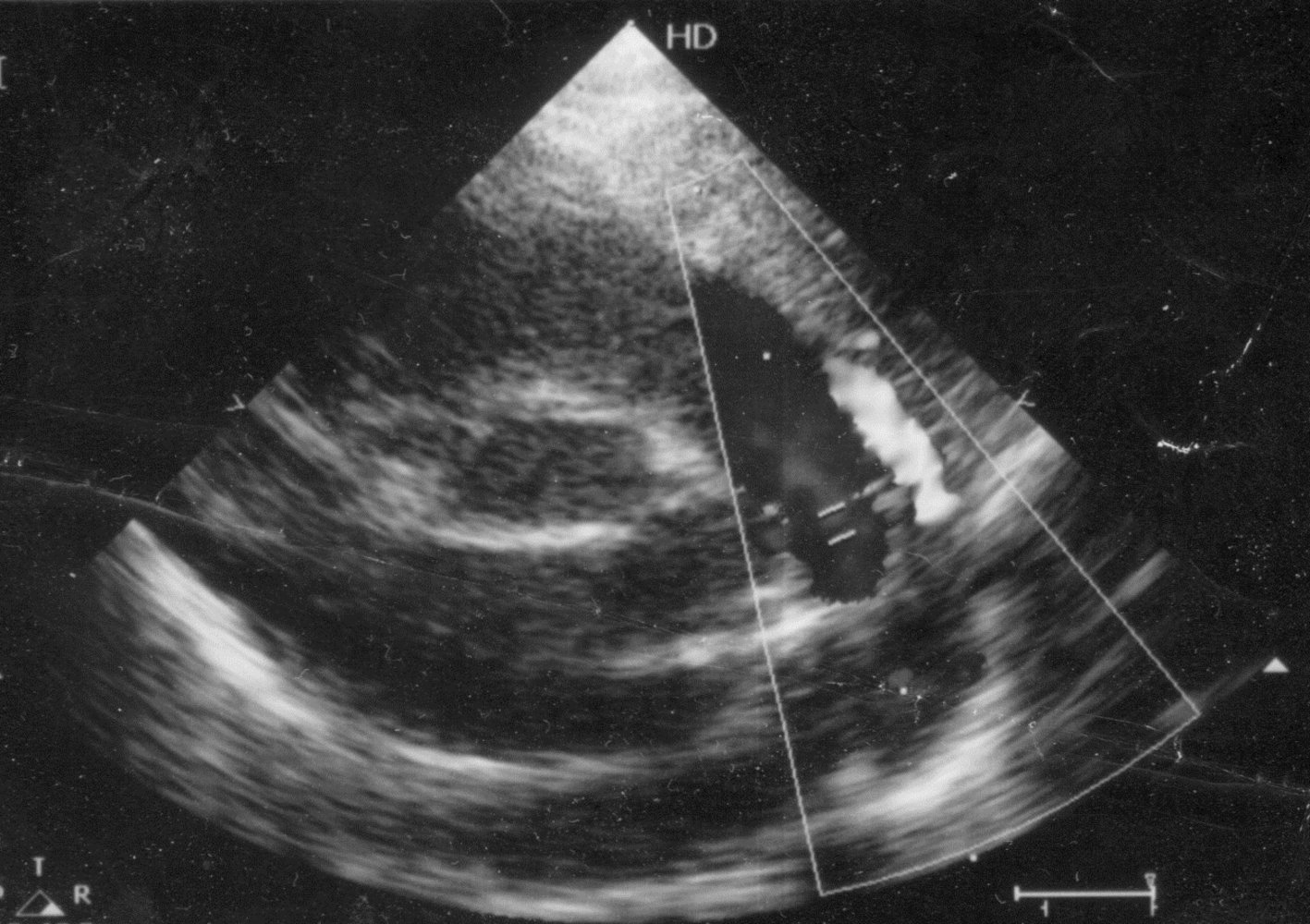Patent ductus arteriosus