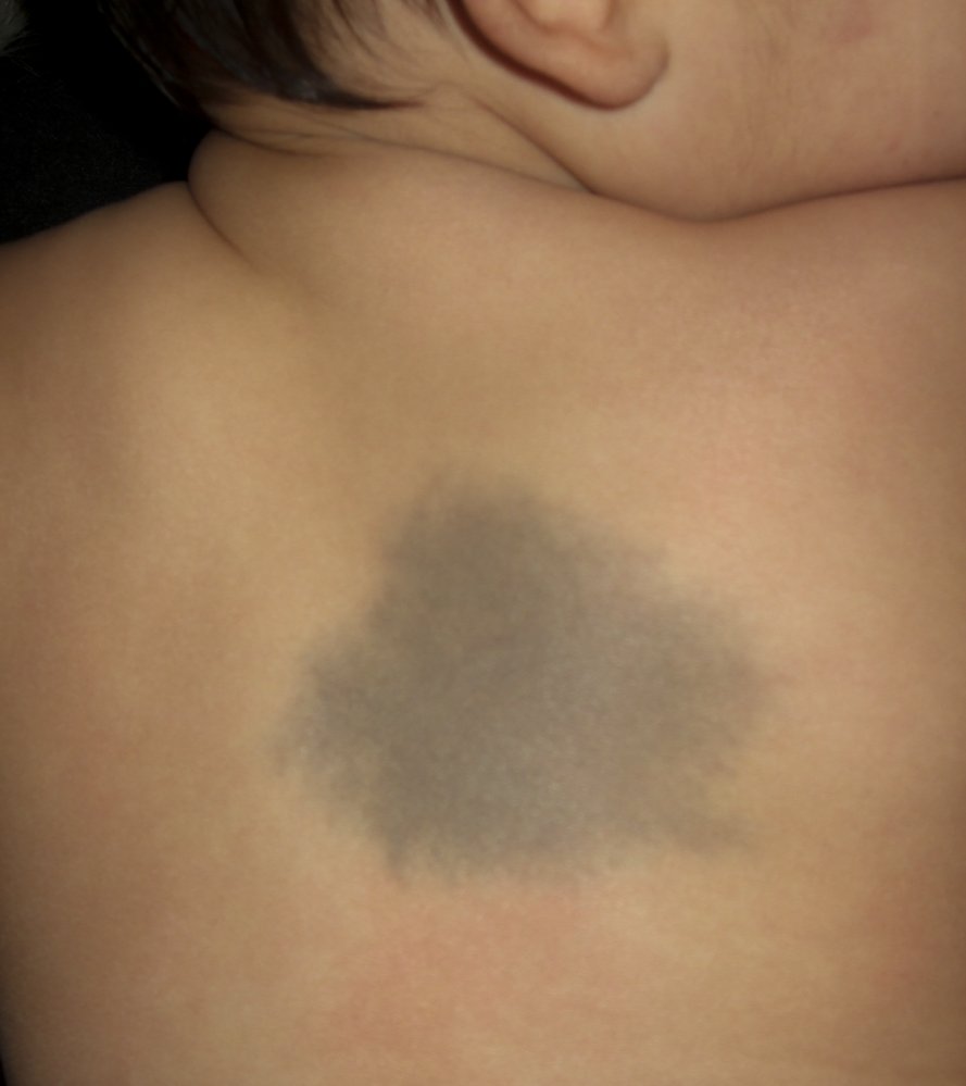 Congenital dermal melanocytosis (Mongolian spot)