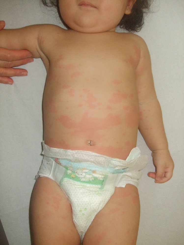 Urticaria
