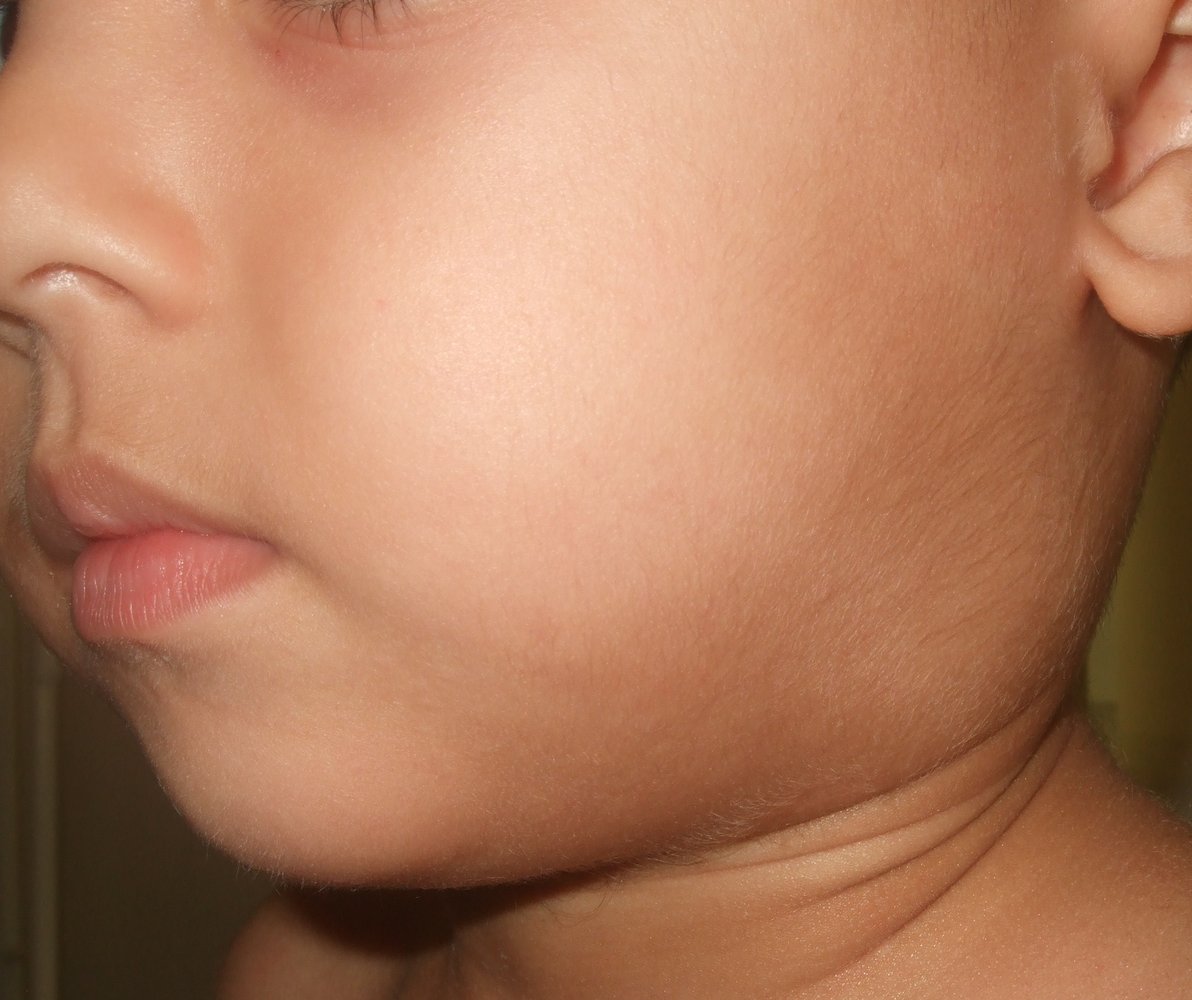 Cervical lymphadenopathy