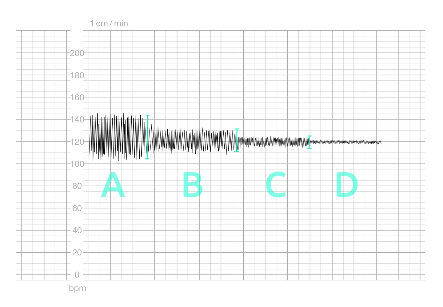 Cardiotocogram (CTG) showing different types of FHR baseline variability