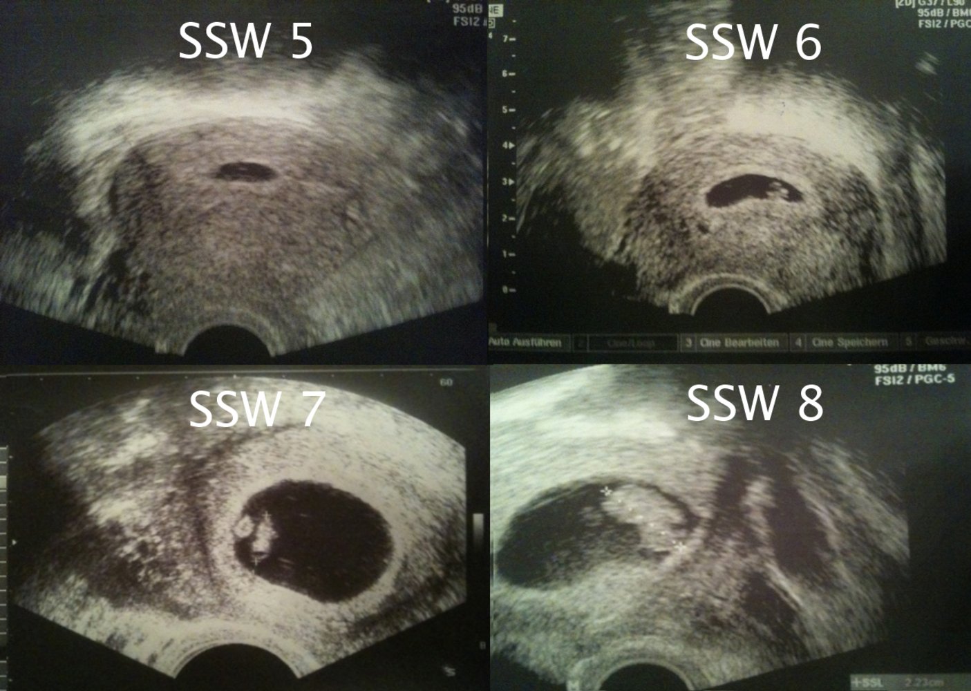 Sonography of embryonic/fetal development