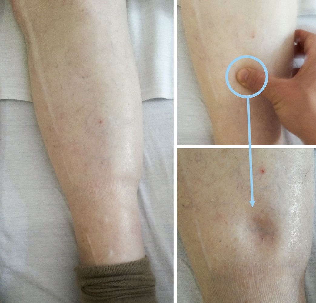 Pitting edema of lower leg