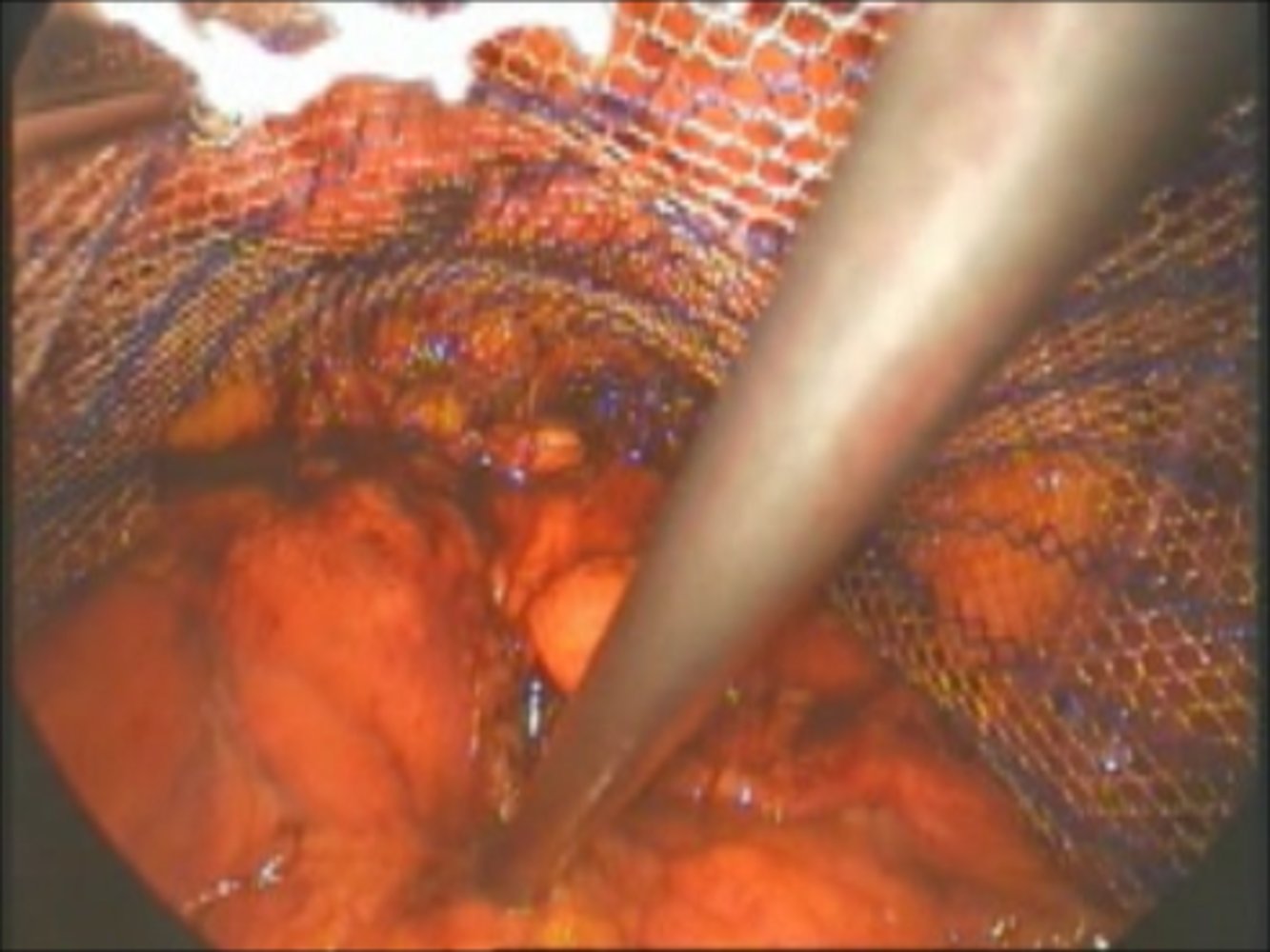 Mesh implementation during an endoscopic repair of an inguinal hernia