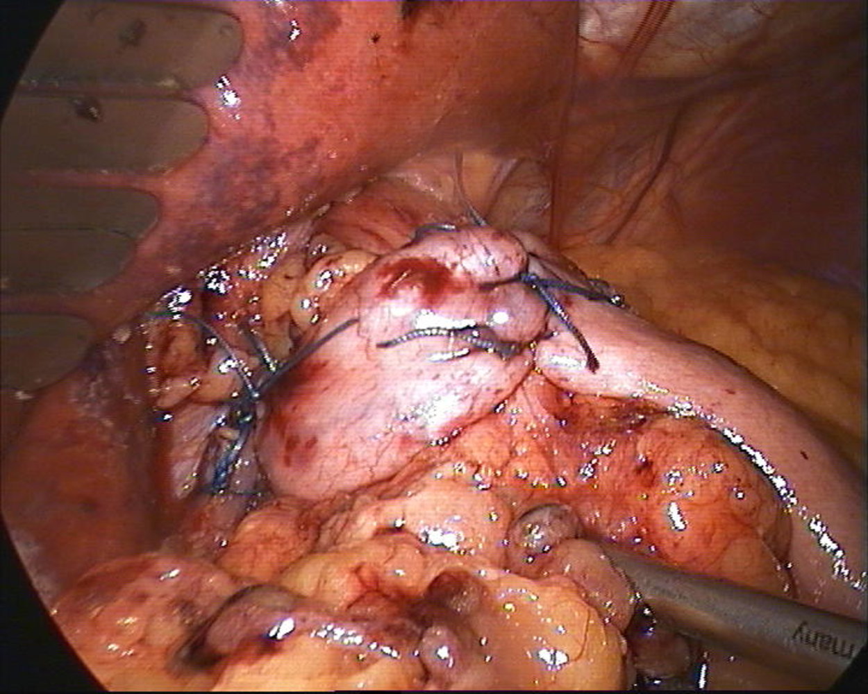 Nissen fundoplication