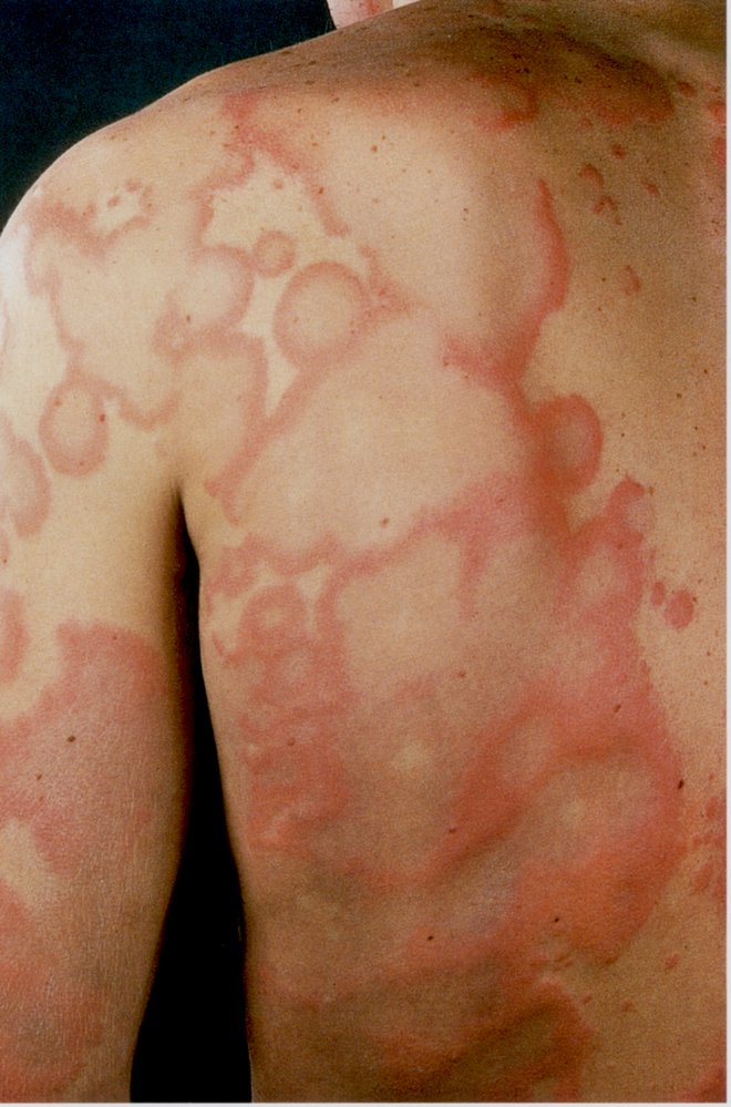 Urticaria