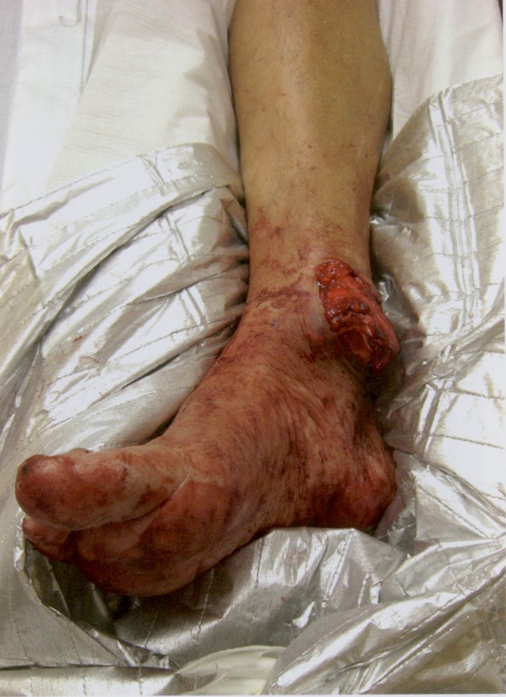 Open fracture of the right ankle