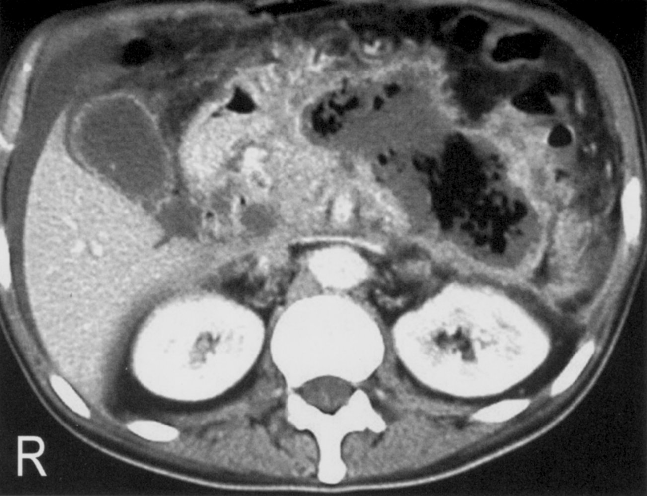 Walled-off necrosis (pancreatic abscess)