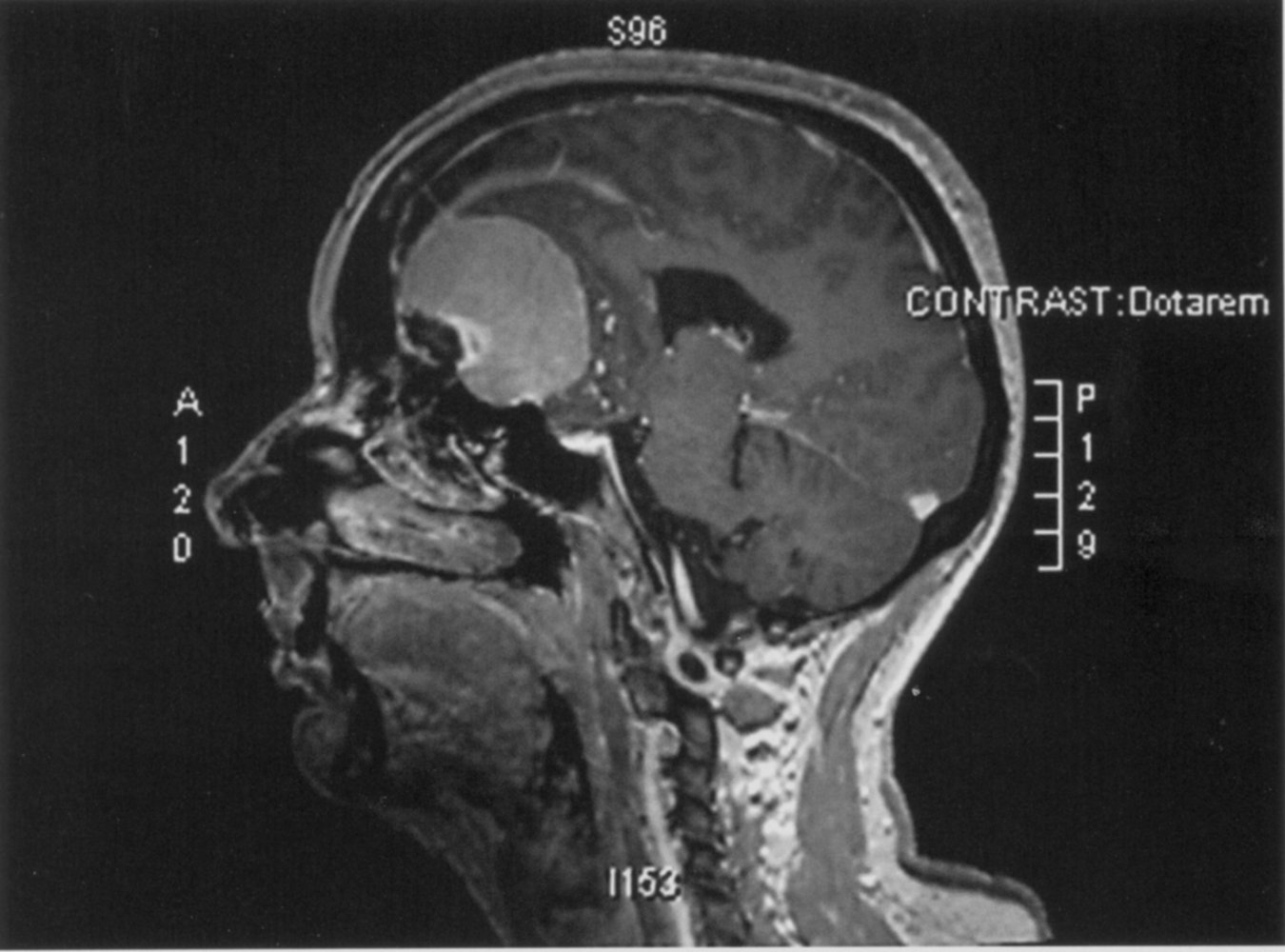 Dural based lesion