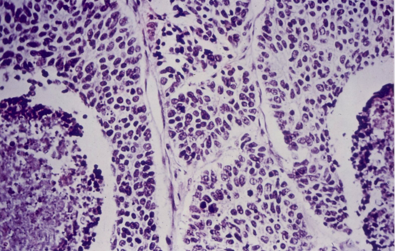 Small cell lung carcinoma