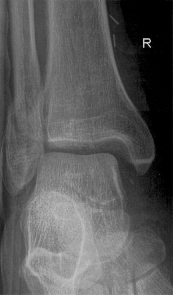 Weber B fracture of the upper right ankle
