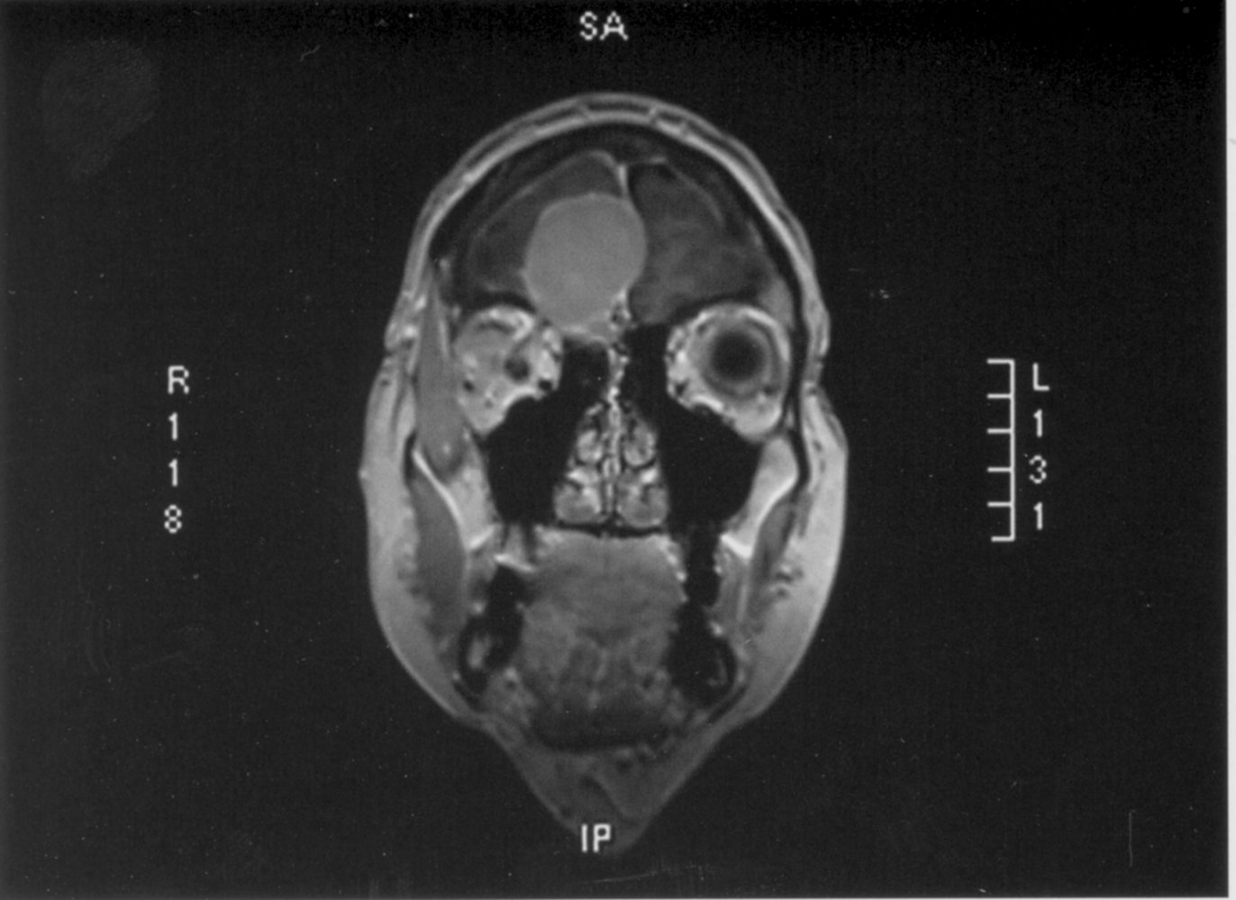 Dural-based lesion