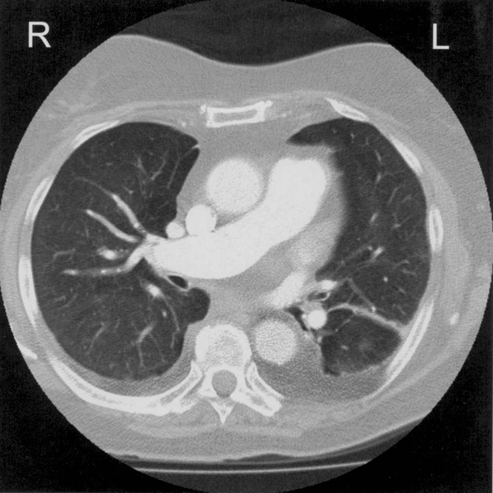 Bilateral pleural effusion