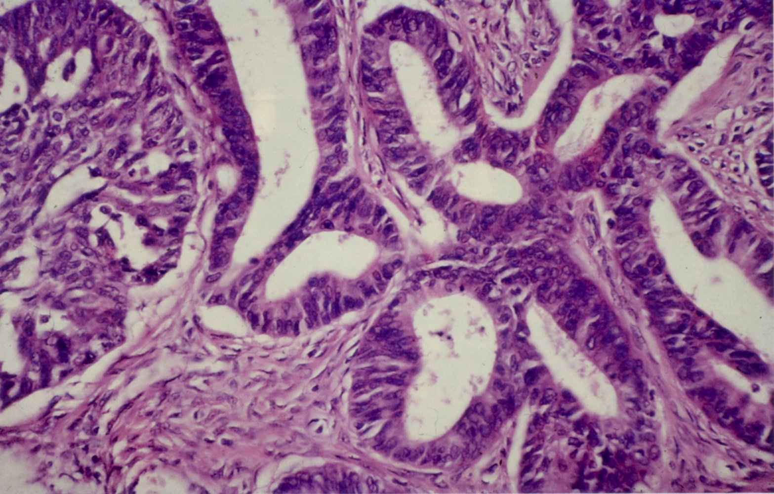 Adenocarcinoma of the lung