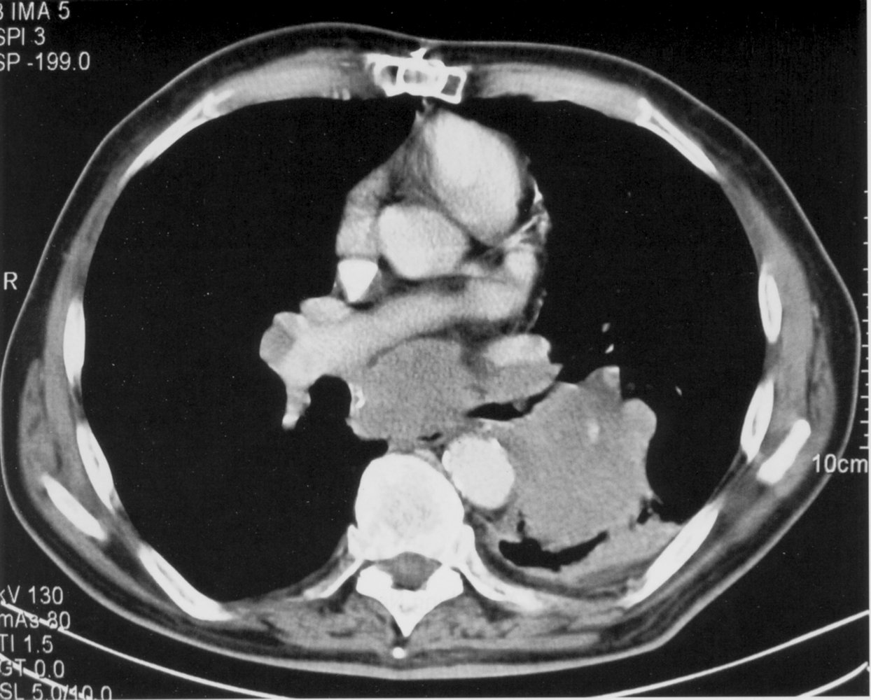 Metastatic lung carcinoma