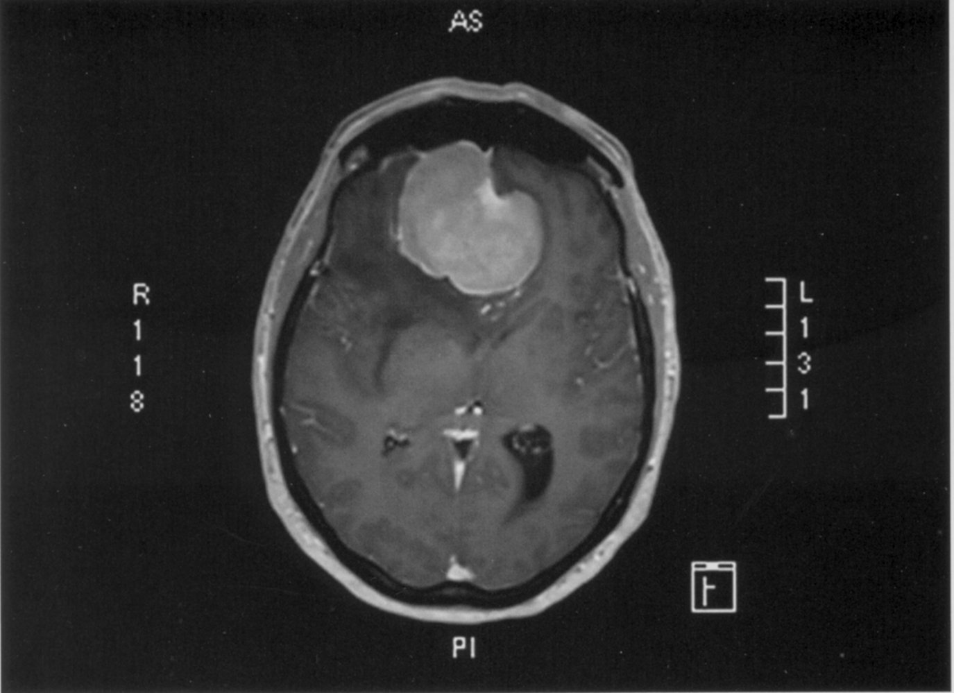 Dural based mass