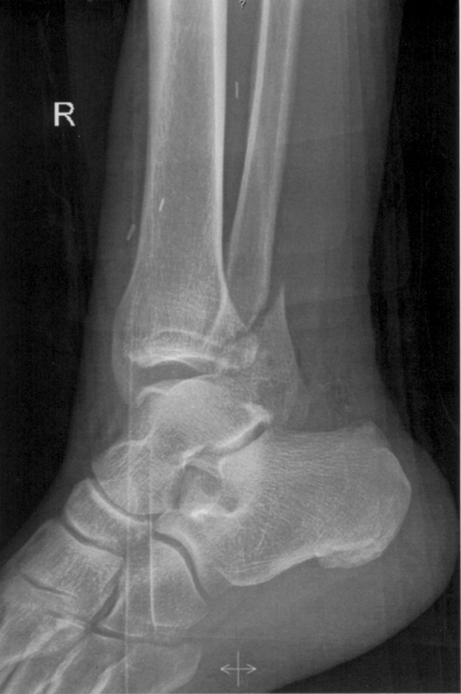 Weber B fracture of the upper right ankle