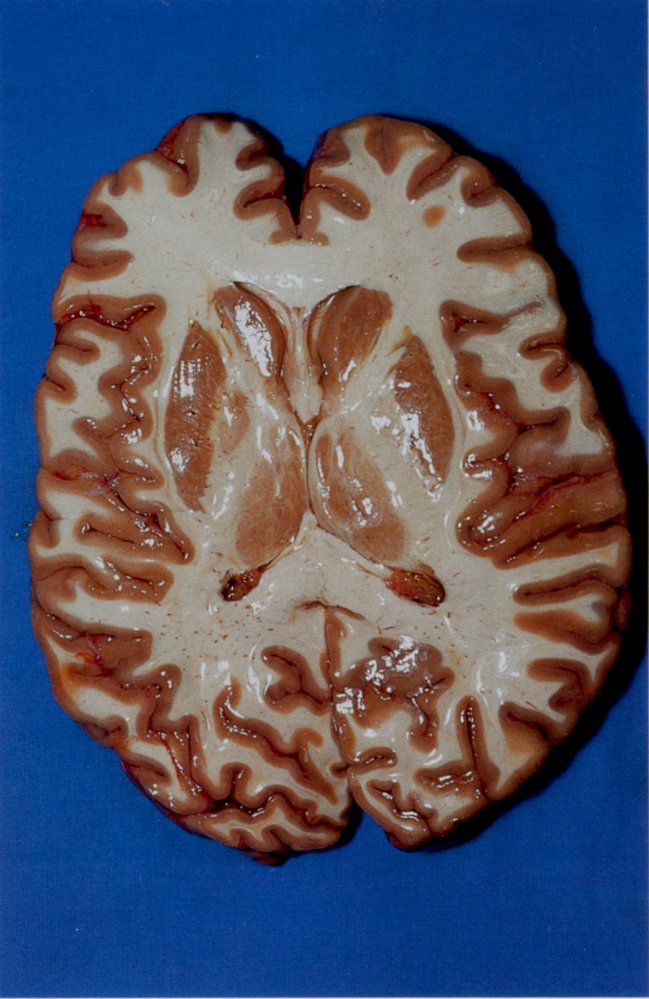 Horizontal section of cerebrum