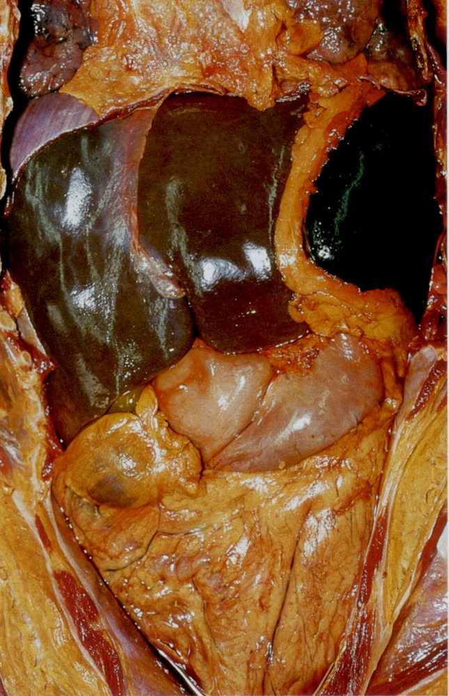 Abdomen of a patient with malaria