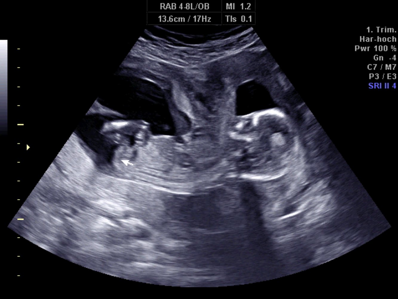 Bicornuate uterus (Uterus bicornis bicollis)