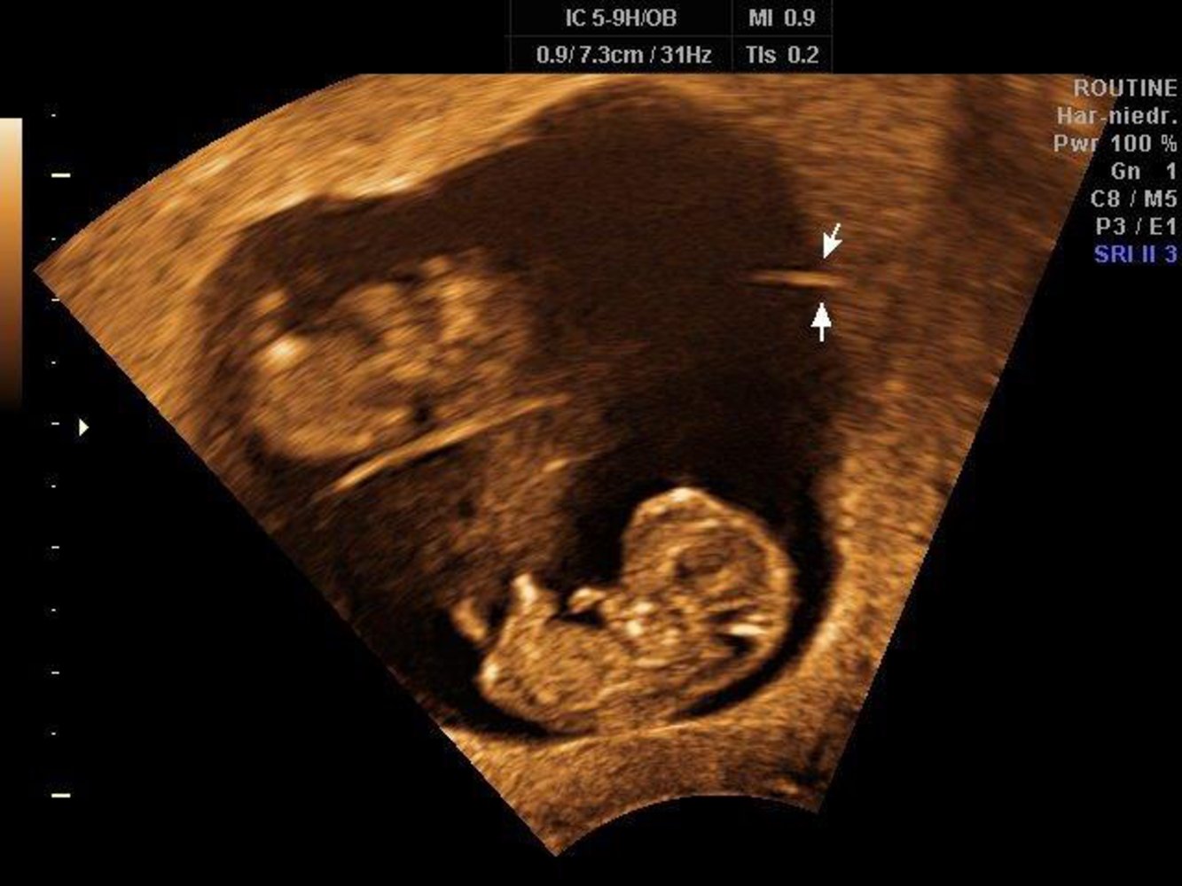 T-sign in monochorionic diamniotic twin pregnancy