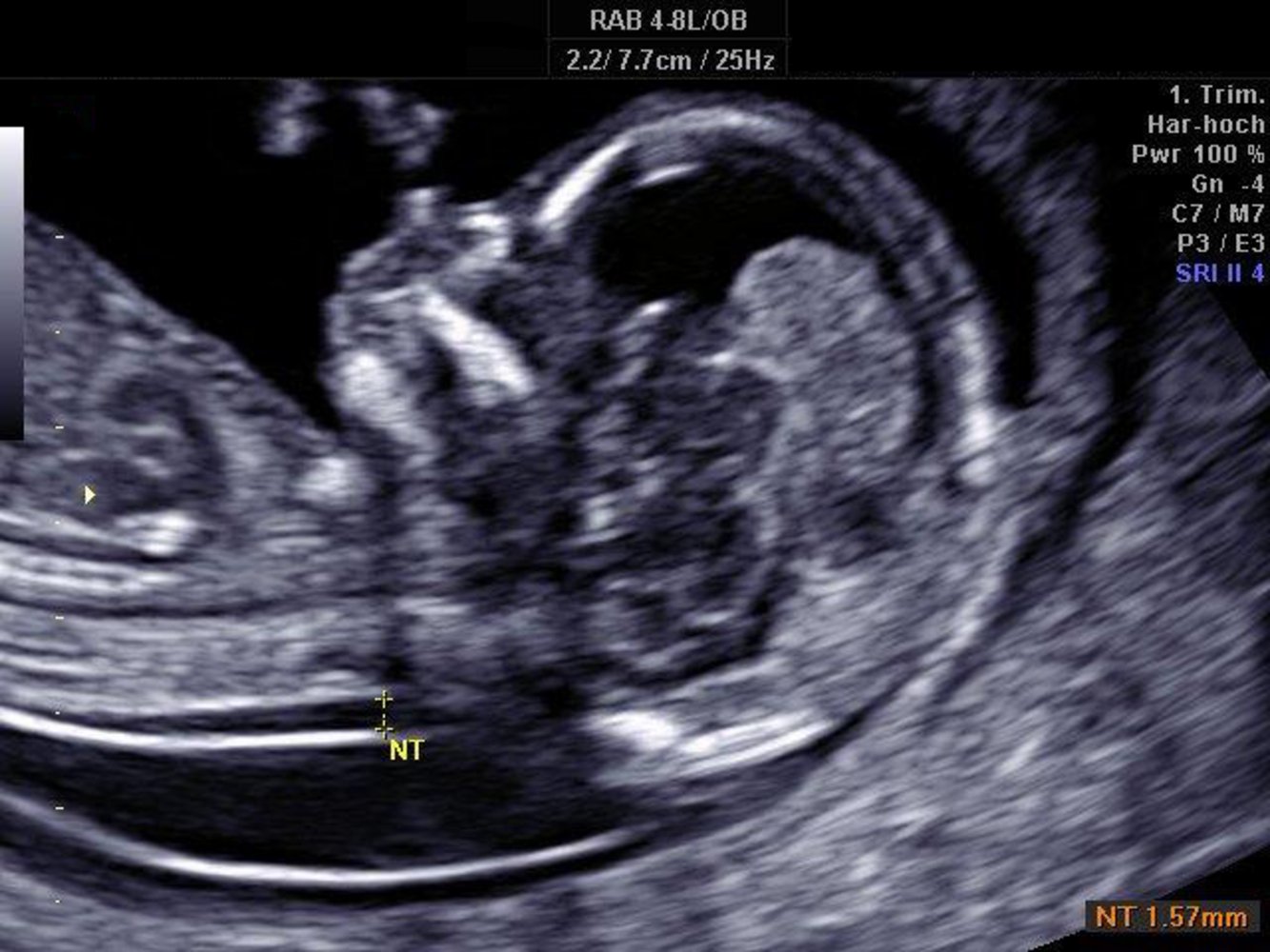 Normal nuchal translucency