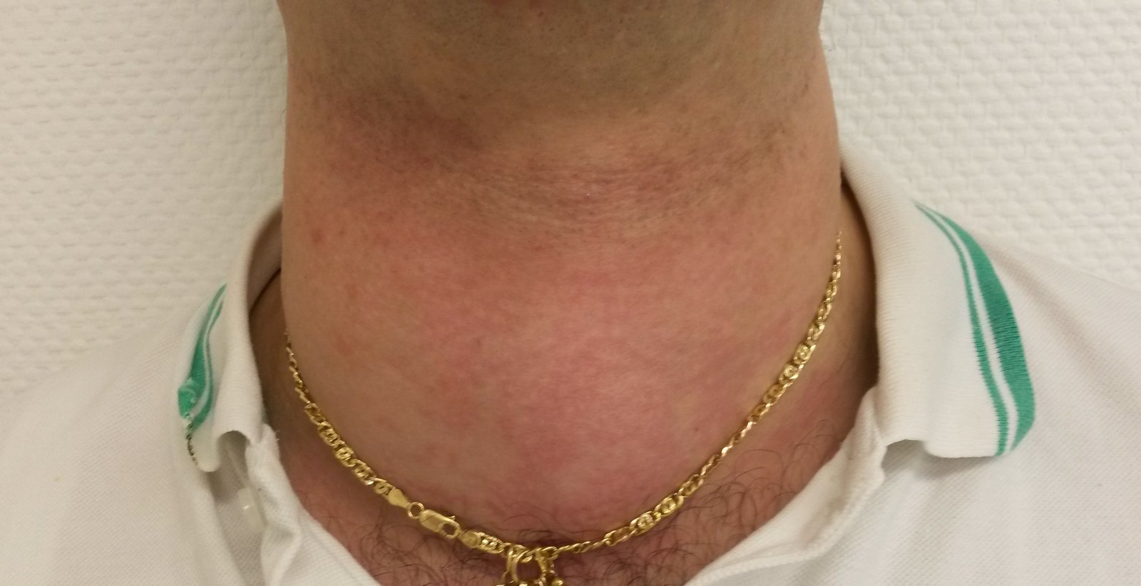 Patient with goiter
