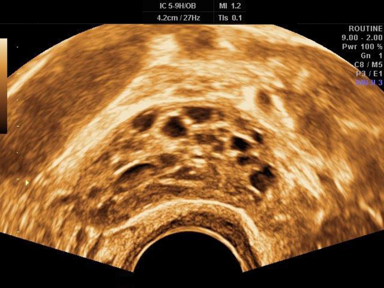 Polycystic ovary syndrome