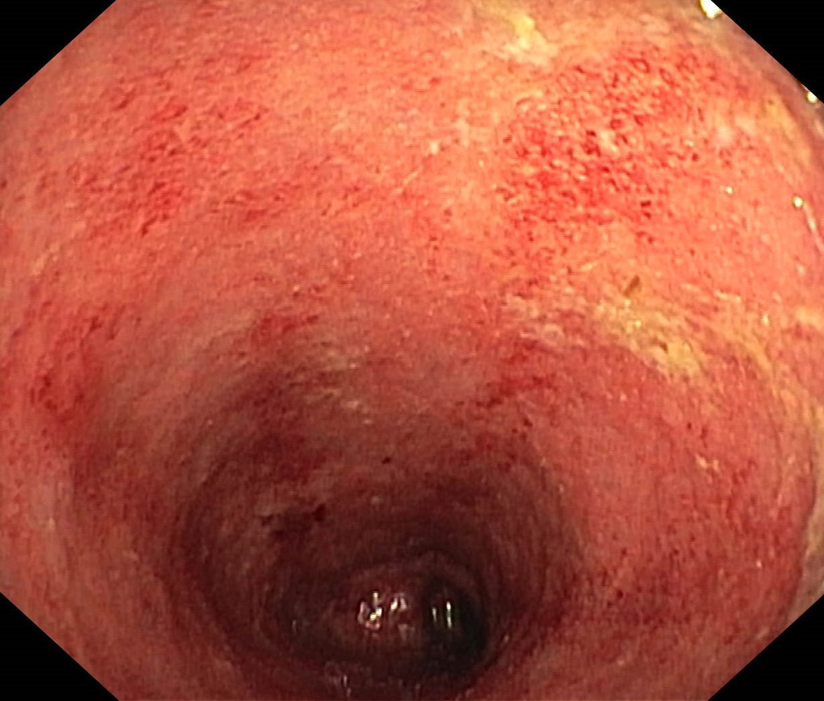 Active ulcerative colitis
