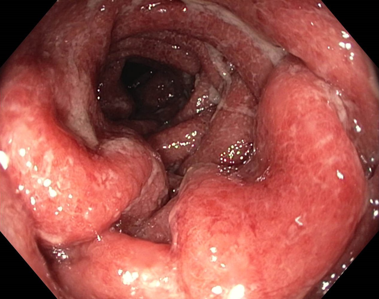 Acute ulcerative colitis