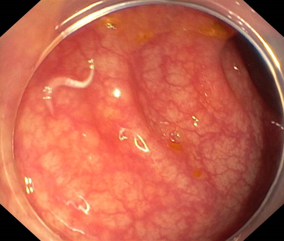 Enterobius vermicularis (pinworm)