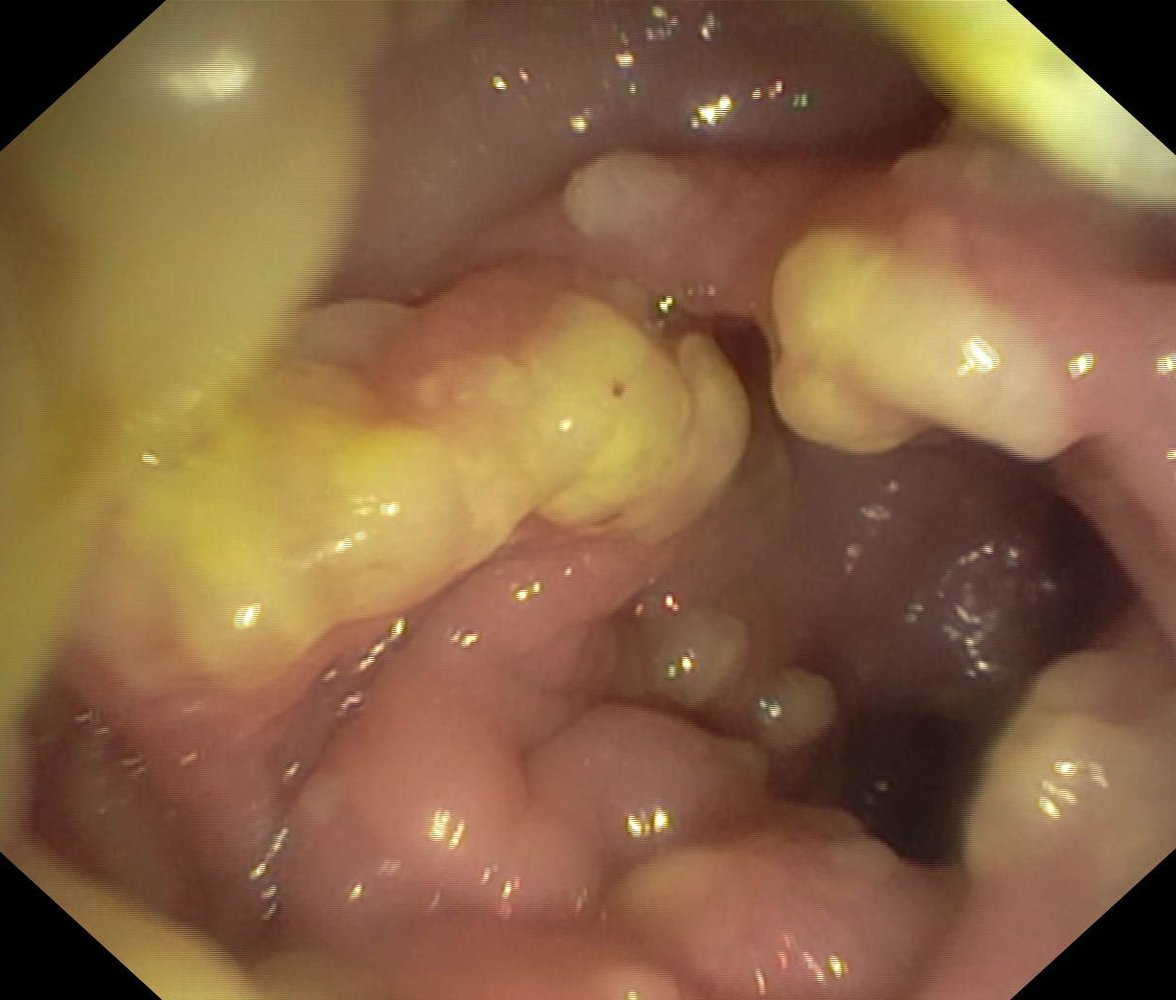 Pseudomembranous colitis