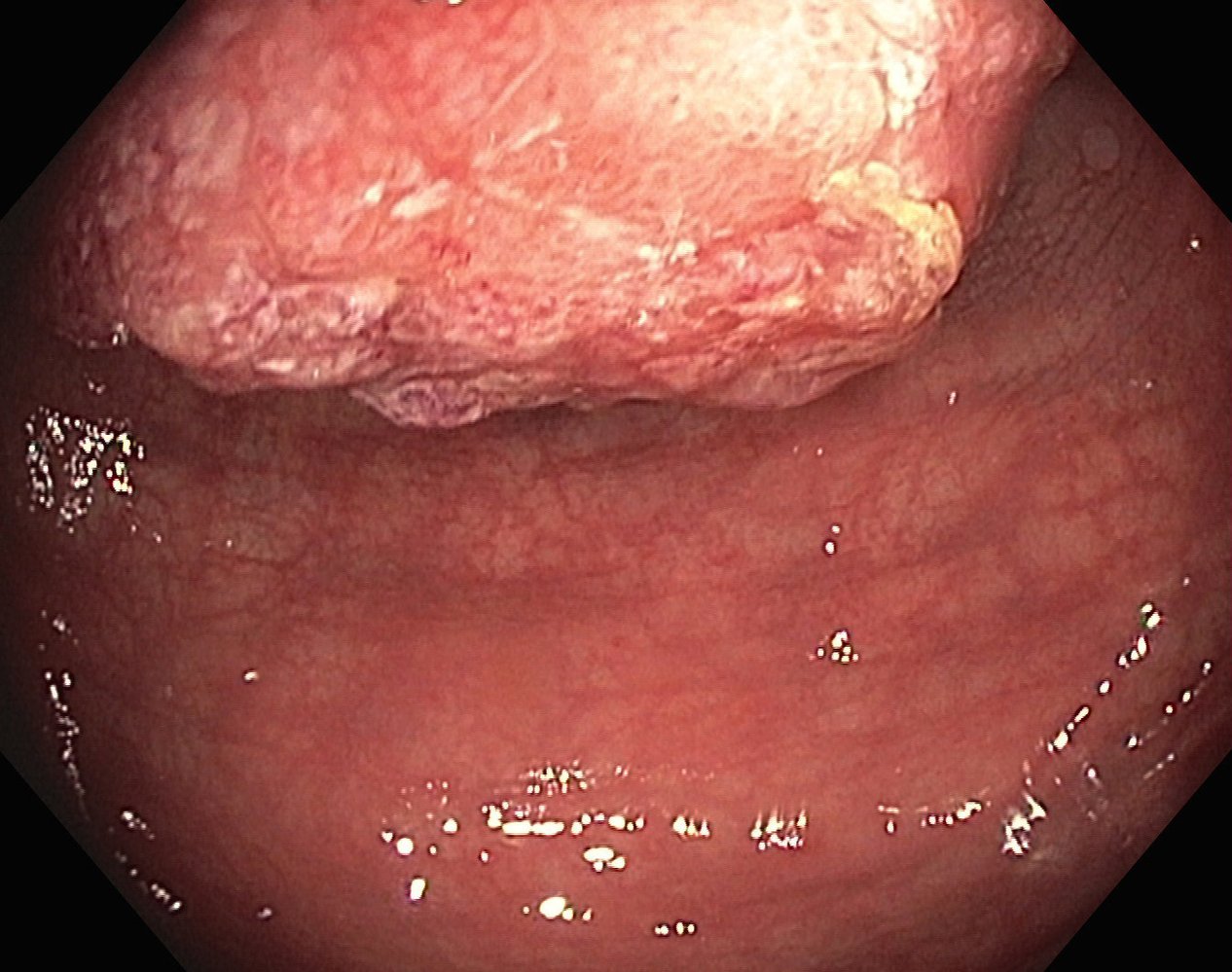 Colon cancer