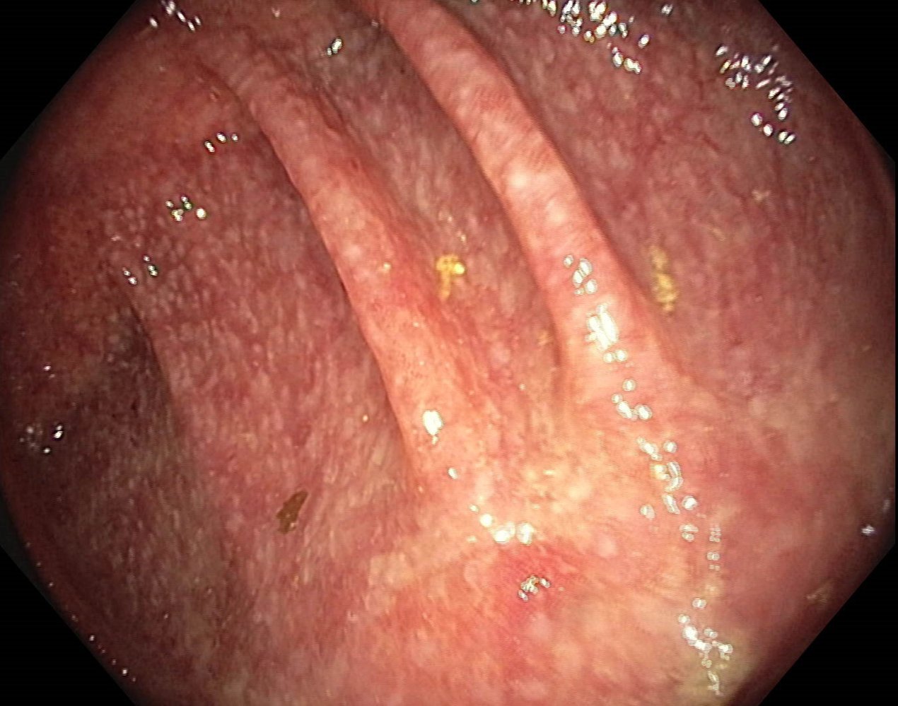 Infectious colitis