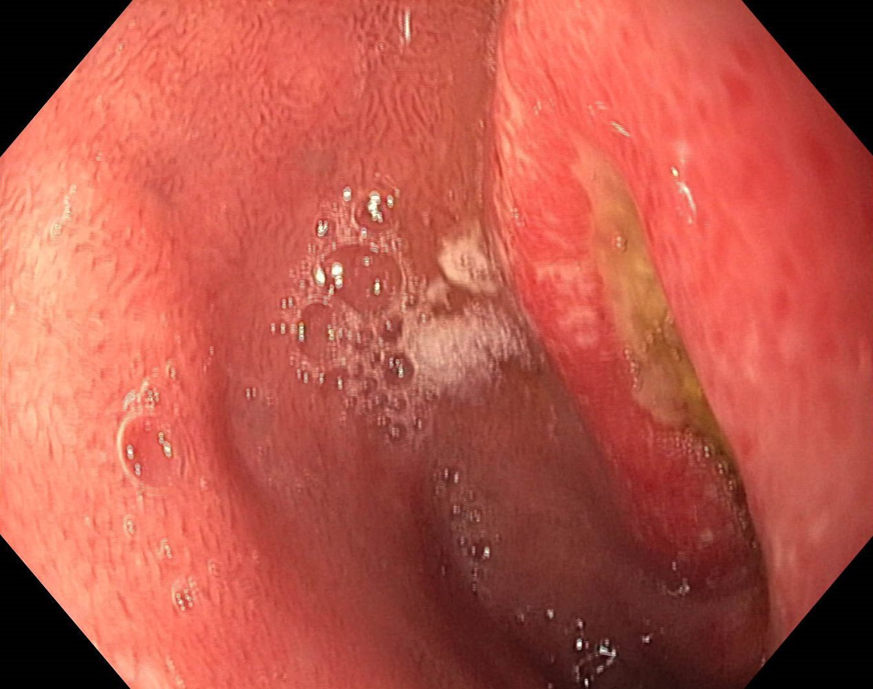 Duodenal ulcer: Forrest stage III