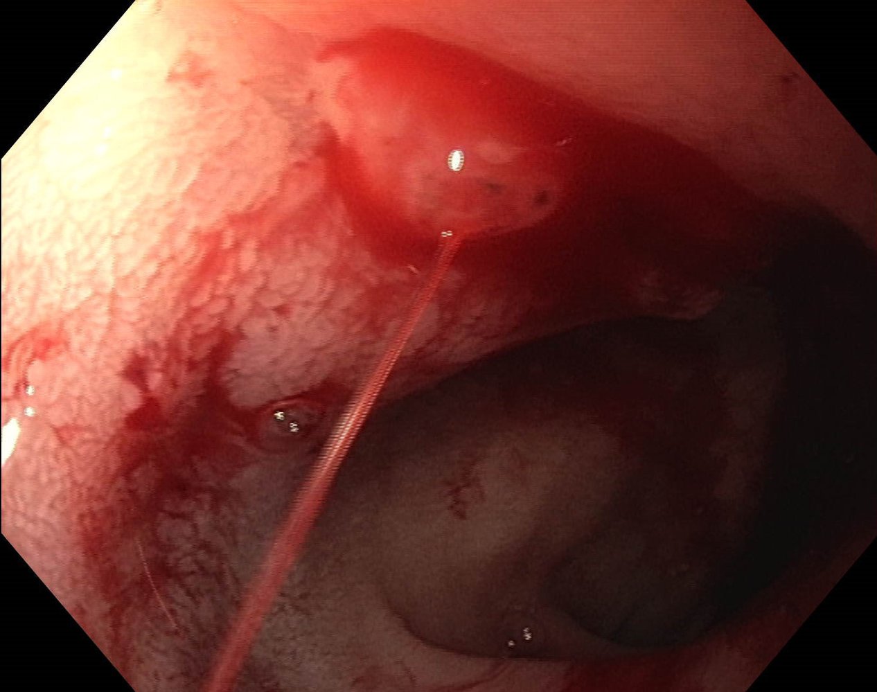 Duodenal ulcer: Forrest stage Ia