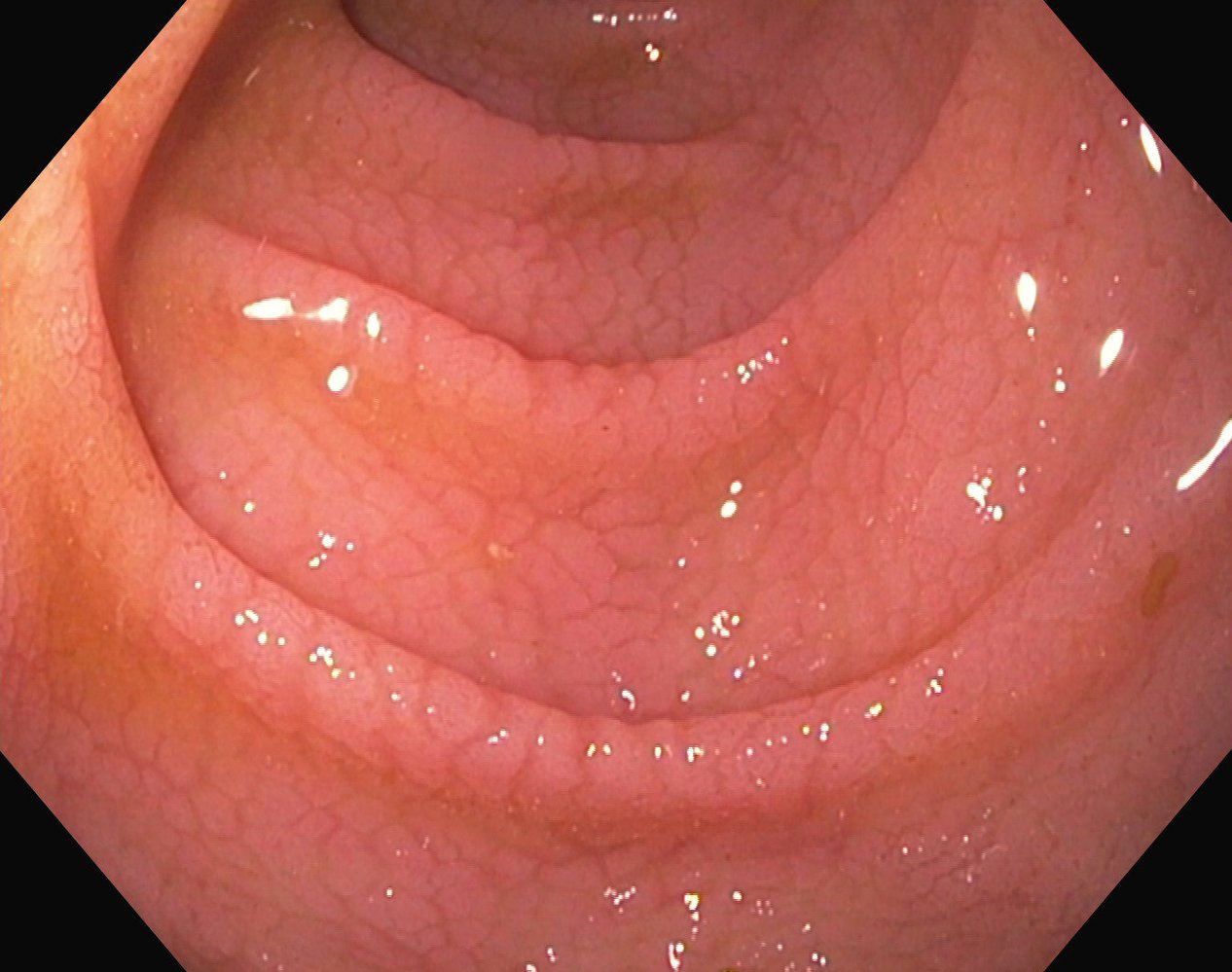 Celiac disease
