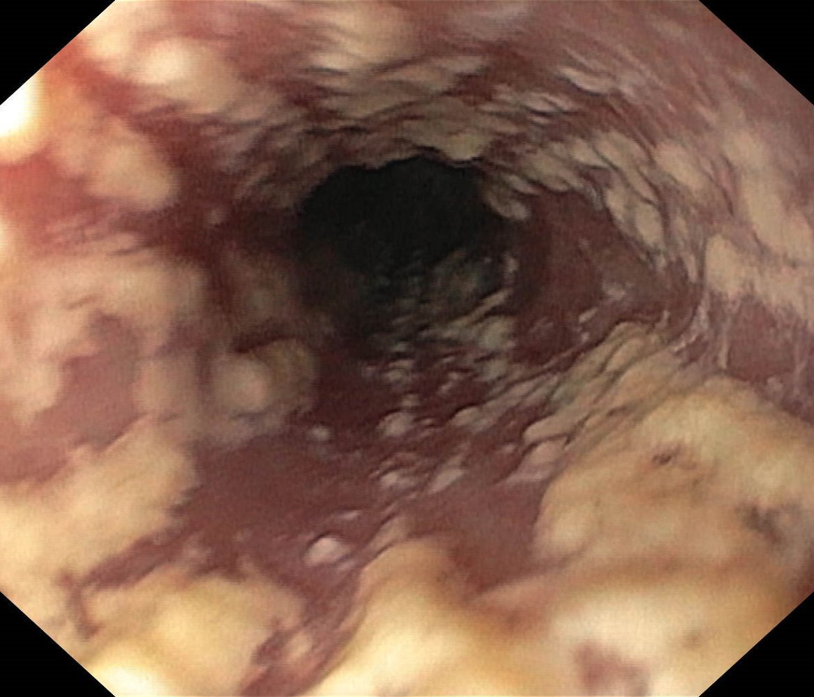 Candida esophagitis