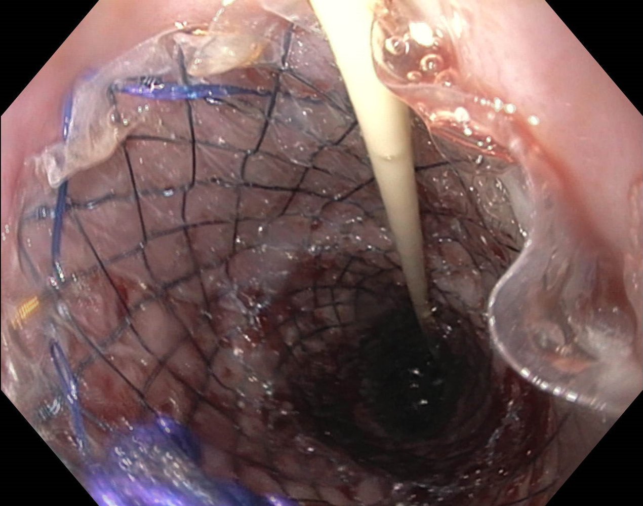 Esophageal stent